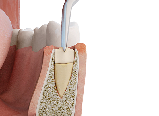 PRGF – ENDORET® Regeneration