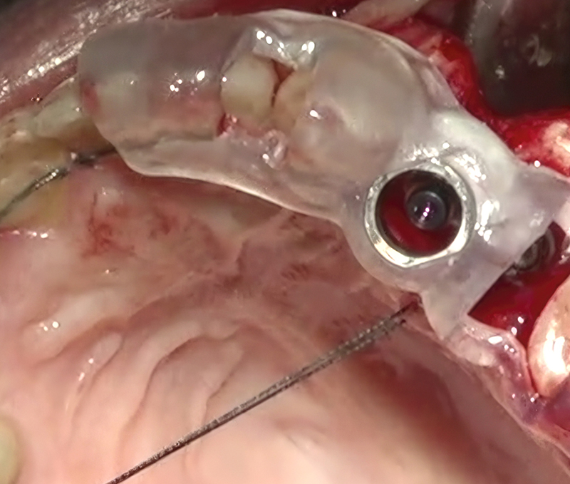 Guided Surgery